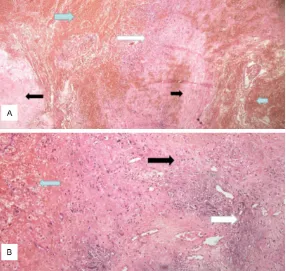 Figure 5. Photomicrographs of the sections of the tumor showing a cavity filled with fibrin, blood cells (blue arrows), granulation tissue (white arrows), and fibrous connective tissue (black arrows)