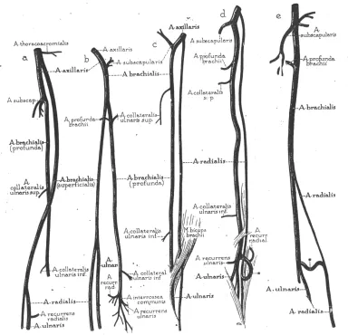 Fig. 2 : VARIATIONS IN THE BRACHIAL ARTERY  (McCORMACK et al.,  BRACHIAL ARTERIAL PATTERNS) 
