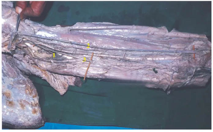 Fig. 9 : PROFUNDA BRACHII FROM COMMON TRUNKWITH SUPERIOR ULNAR COLLATERAL ARTERY