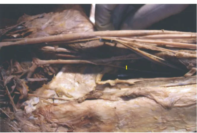 Fig. 11 : PROFUNDA BRACHII FROM AXILLARY ARTERY