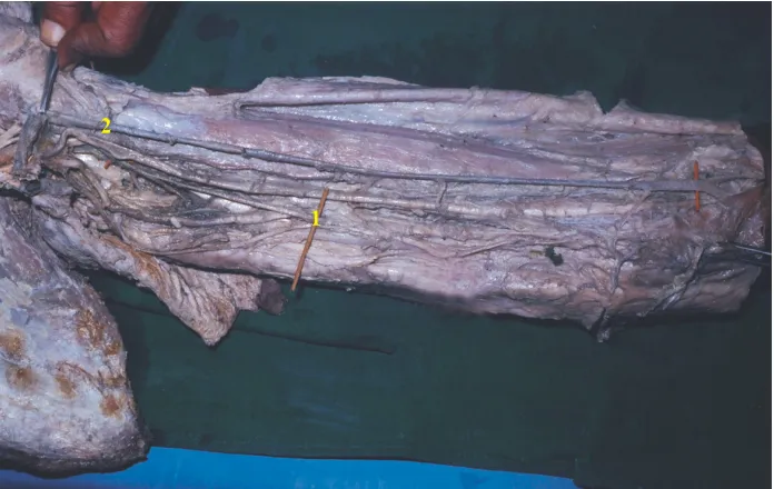 Fig. 14 :  ORIGIN OF SUPERIOR ULNAR COLLATERALFROM COMMON TRUNK WITH PROFUNDA