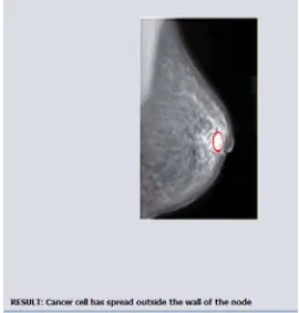 Fig. 3: Final Output Image with Cancer