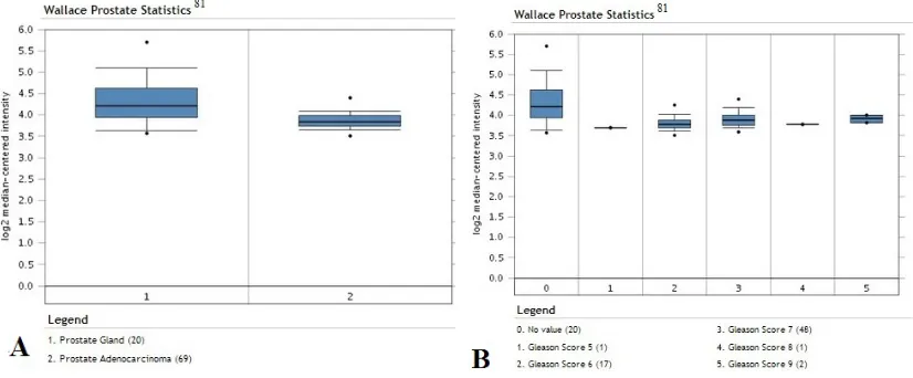 Figure 3: Similar YY1 expression in prostate cancer in datasets by Taylor et al [82]. Analysis of data for prostate cancer; 179 surgical specimens from radical prostatectomy and 6 cell lines used for data analysis