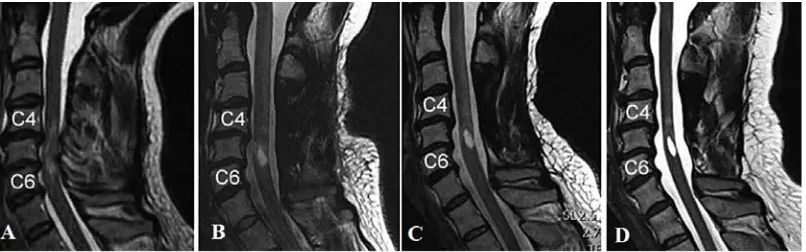 Fig. 1: CT scan of the cervical spine revealingposteriorly displaced C7 vertebral bodyimpressing spinal cord