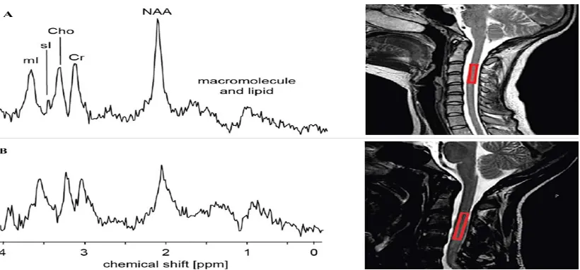 Fig. 4: 1H-MR spectrum images of the upper cervical spinal cord in healthy volunteer (A) andpatient with cervical tSCI (B)
