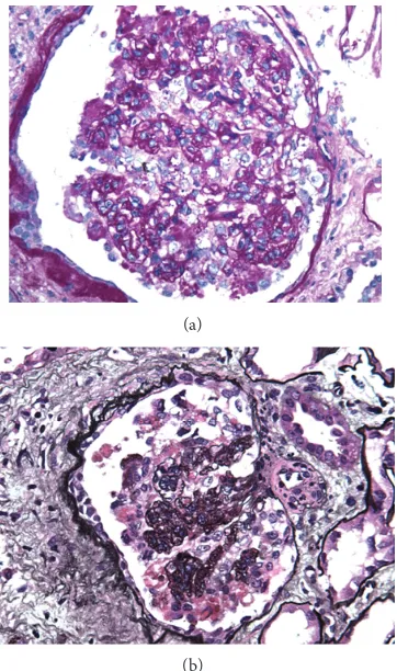 Figure 2: Light microscopy of the kidney biopsy. Glomeruli dis-played lesions of collapsing glomerulopathy which ranged fromsegmental to global are shown by periodic acid-Schiff (a) andmethenamine silver staining (b).