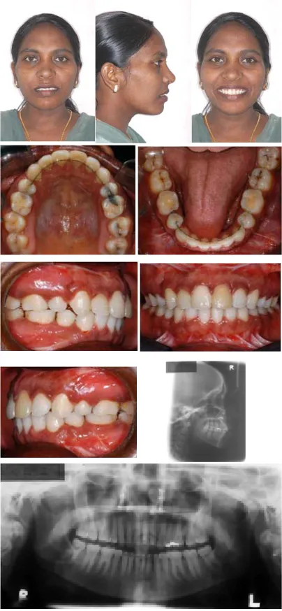 Fig. 5: Post treatment Intraoral