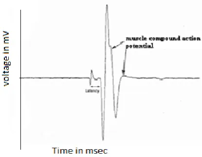 Figure 3 shows the Ulnar nerve response of a normal 