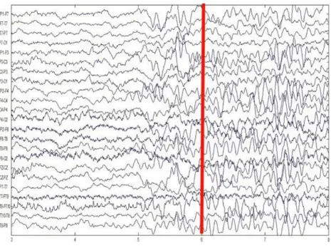 Figure 1.1 Changes in EEG signal during onset of Epileptic seizure [INTR9]. 