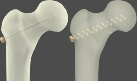 Figure 1 – Image of the bone-implant system  with telescopic implants 