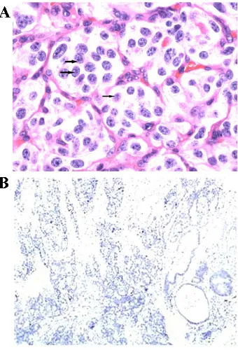 Figure 1. Positive staining of Ki-67 showed purple or brown-purple granules. Results indicated The result of immunohistochemistry of Ki-67 in NET and control tissues is shown in that Ki-67 was highly expressed in the nuclei of the epithelial cells of NET tissue.