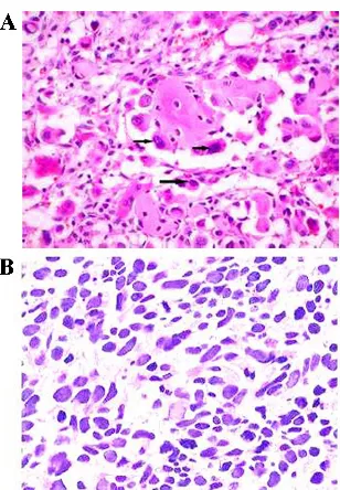 Figure 2. Immunohistochemistry staining of caspase-3 in NET tissues (A) and para-carcinoma tissue (B)