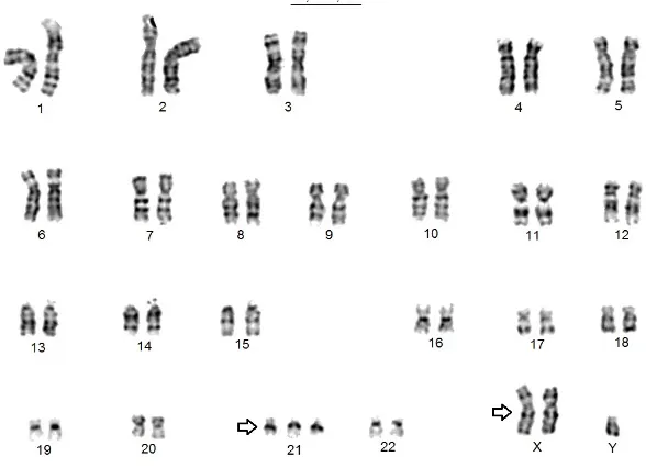 Figure 1. G-banding karyotype of the patient with double aneuploidy 48,XXY,+21.