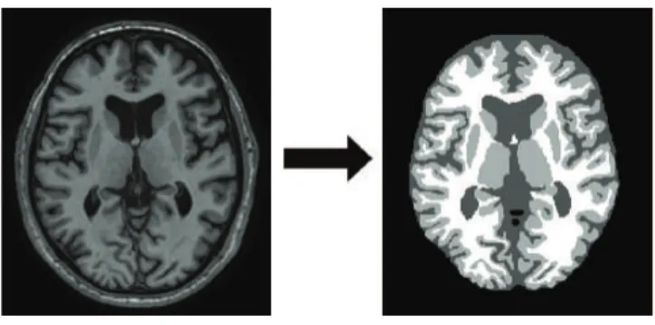 Figure 1.1: Example of medical image segmentation. Left: a slice of an MR image of the brain