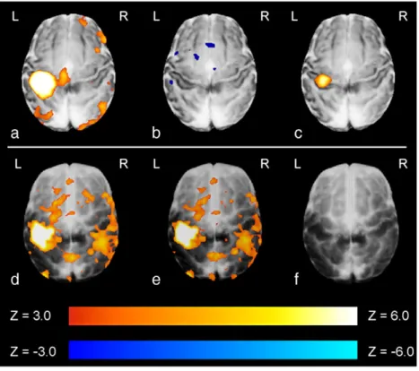 Fig. 5. Example peristimulus timeseries data derived from clusters of activation (inset pictures, red) identiﬁed following passive motor stimulation of the right hand