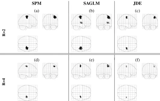 Figure 9: RFX statistical analysis for the Lc - Rc contrast and acceleration factors R = 2 (a-c) and R = 4 (d-f), derived using the GLM (a,d), SAGLM (b,e) and JDE (c,f) subject-level analyses