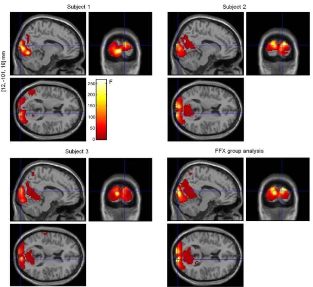 Fig. 4. Effect of visual ﬂicker stimulation on fMRI data. Single-subject analyses (3 sessions per subject) and ﬁxed-effects group analysis (9 sessions in total), pb0.05 (FWE)