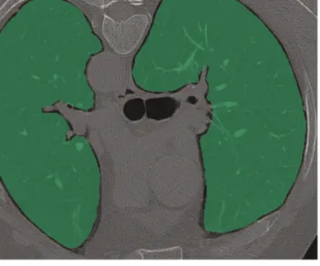 Figure 1. Axial chest CT image in prone position. The 2 green areas comprising the lung parenchyma represent the ROIs used for texture analysis at the level of the tracheal carina