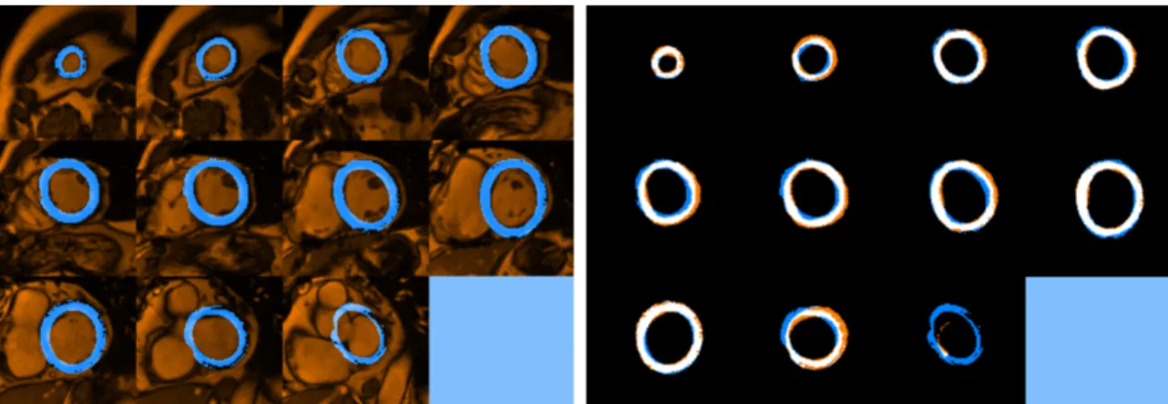 Figure 3.5: a) Final myocardium segmentation of all slices of a patient dataset (shown in blue) superimposed with the patient volume (shown in red); b) Final myocardium segmentation assessed against the provided gold-standard semi-automatic  segmenta-tion;