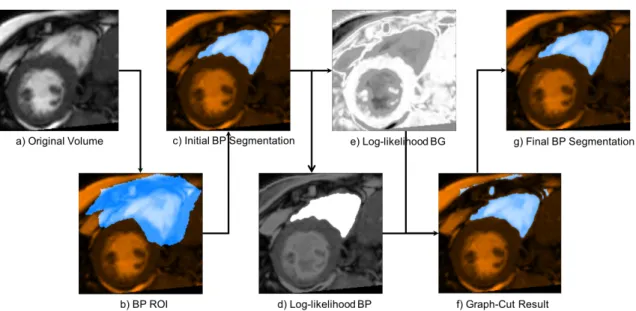 Figure 4.2: BP Segmentation procedure: a) original MR image slice, b) the initial BP ROI obtained by thresholding the BP probability map, c) initial BP segment obtained by otsu thresholding and cleaning; d) BP likelihood and e) BG  log-likelihood obtained 