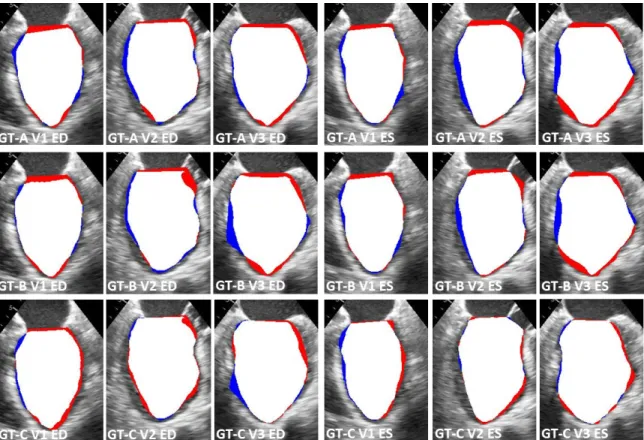 Figure 2.6: Visual comparison of the blood-pool annotations achieved via A — auto- auto-matic feature detection from individual frames; B — single phase automated feature detection + registration-based propagation; and C — single phase expert manual  an-no