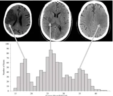 Figure 1  Histogram of average infarct intensities of the manually  delineated infarcts