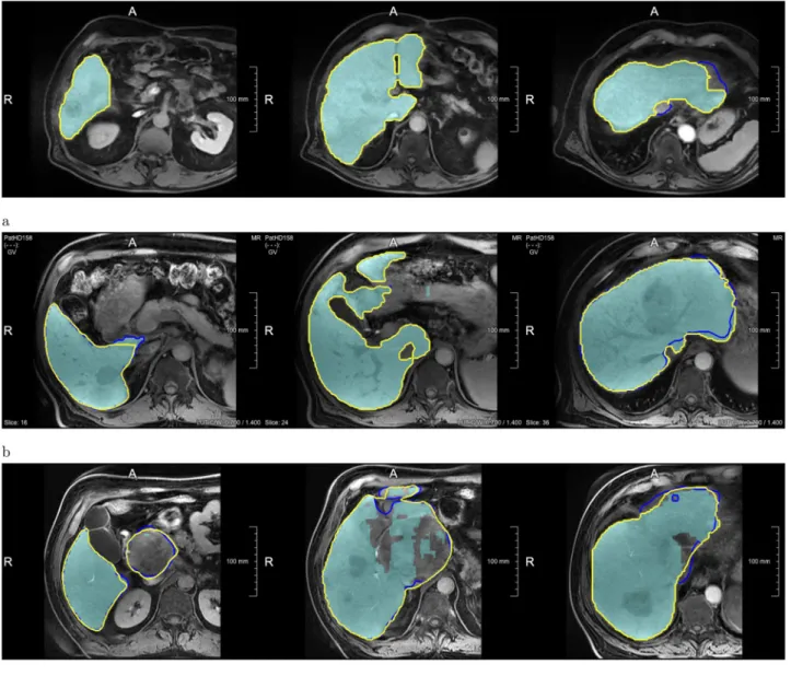 Fig 6. Examples showing how the automatic Liver-Net results (cyan) were corrected. The contours denote corrected liver masks by Res3 (blue) and RA (yellow)