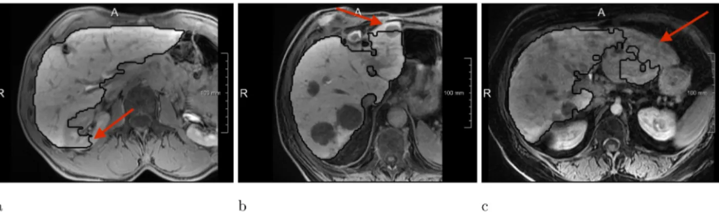 Fig 8. Most common error types of the Liver-Net approach. (a) Leakage into surrounding structure of similar image intensity