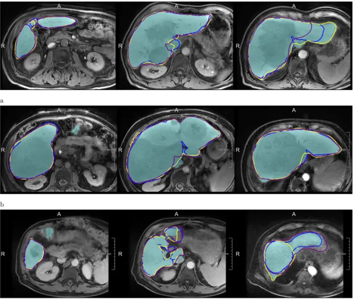 Fig 4. Examples of segmentations produced by the Liver-Net (cyan) compared to three routine delineations by Rad (blue), Res1 (yellow) and Res2 (purple)