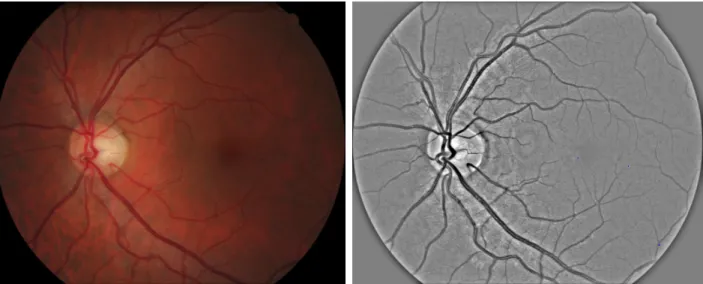 Figure 1. Example image from E-Ophtha EX dataset. From left to right: original image; preprocessed image.