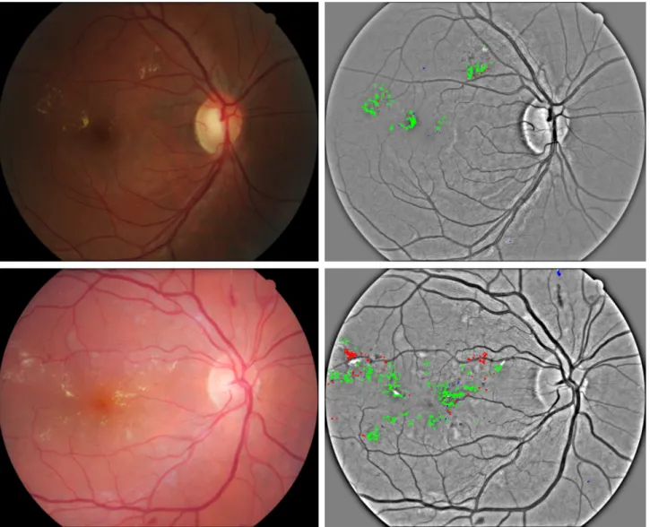Figure 3. Examples of exudate segmentation results for E-Ophtha EX dataset using 0.5 probability threshold