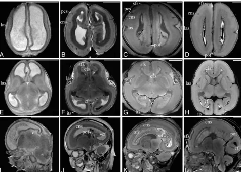 FIG 3. 3D visualization model of the telencephalon, cerebellum, and brain stem of 12 (A), 16 (B), 20 (C), and 22 (D) weeks GA
