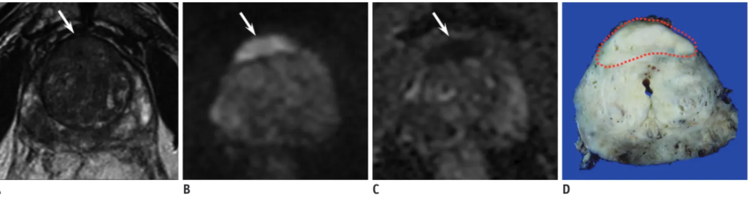 Fig. 1. 69-year-old man with serum PSA level of 18.6 ng/mL and biopsy-proven GS 6 PCa.