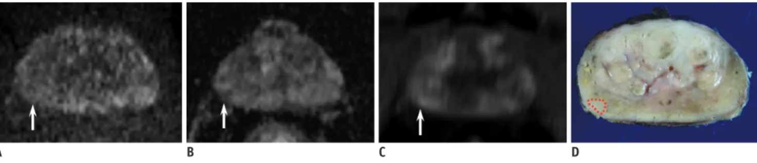 Fig. 3. 67-year-old man with serum PSA level of 22.4 ng/mL and PCa.