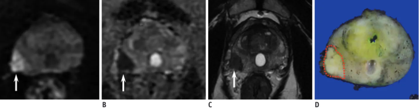 Fig. 4. 54-year-old man with serum PSA level of 6.2 ng/mL and PCa.