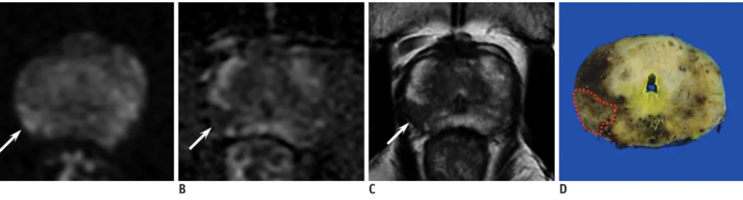 Fig. 5. 44-year-old man with serum PSA level of 22.0 ng/mL and PCa.