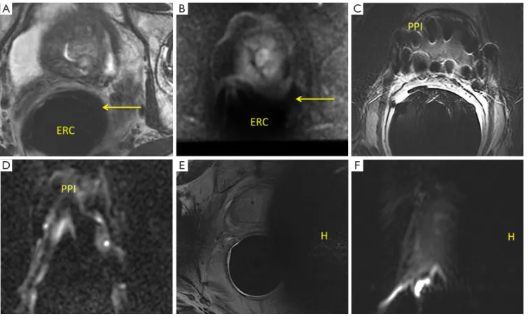 Figure 5 Examples of the effects of susceptibility artifact on axial T2WI and DWI. In Figure 5A, an endorectal coil (ERC) is in place