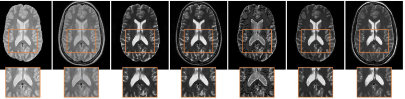 Fig. 2.5 Axial views of synthesized HR T2-w examples based on the LR PD-w inputs using different methods (zoom in for details).