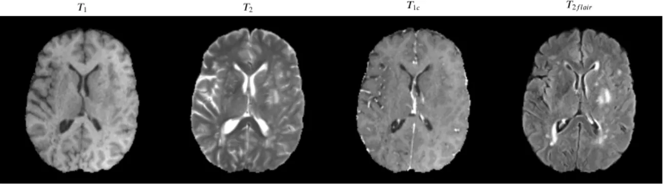 Figure 1.1: Common MR sequences acquired for a patient. Axial slices from a high grade glioma (HGG) patient from BraTS2018 are shown.