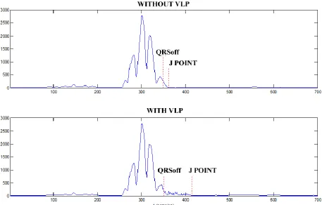 Figure 6: Characteristic points J and QRSoff located on the VM signal with and without the VLP  