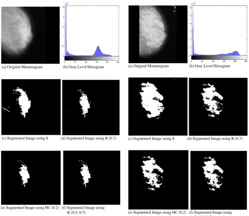 Fig. 2. (a)Dense-glandular mammogram (mdb236) of mini-MIAS database, (b) its gray level histogram, and (c), (d), (e) and (f) segmented images using Kapur entropy (Renyi entropy (07.), Havrda &Charvat entropy (2.0) and ,5.07.0) based techniques respectively 