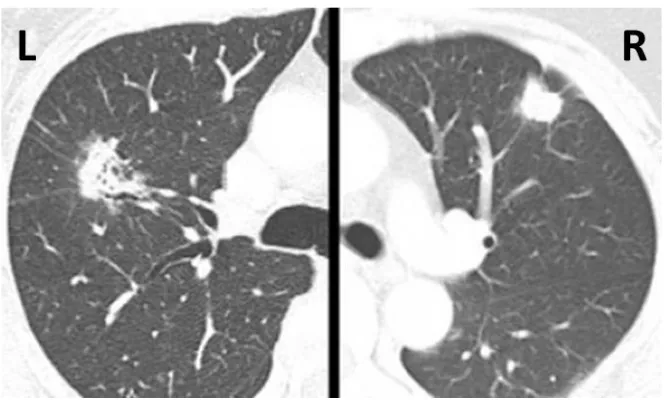 Figure 1.6: CT-Scan of SPN in the lungs. The right lung has a peripheral lesion, which is easier to detect compared to the lesion in the left lung, which is deeper in the lung parenchyma and difficult to detect using palpation 