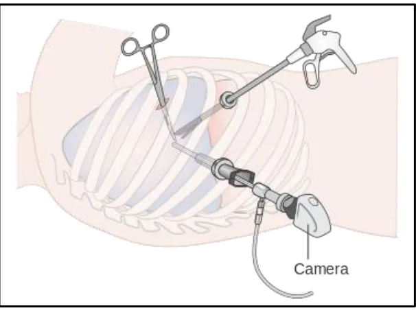 Figure 1.7: Schematic of VATS 