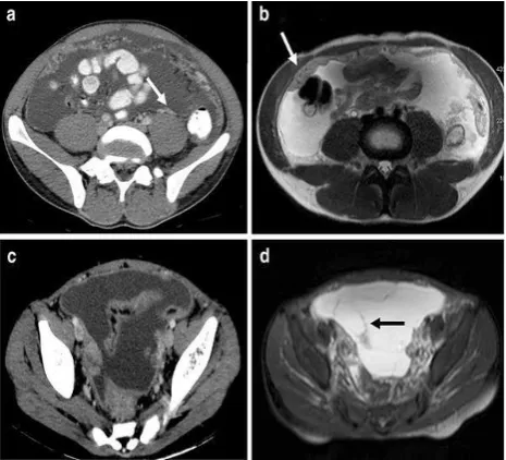 Figure 7: Peritoneal tuberculosis. (a): Ax contrast-enhanced CT; (b): Ax T2 weighted; Smoothly ascites in pelvis with enhancing peritoneum