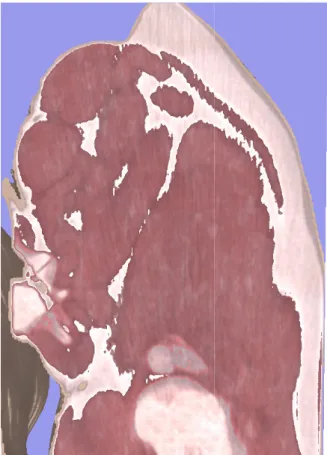 Figure 9: A close up of the visualized volumetric  data showing computed tomography artifacts.