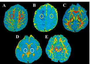 Table 1. Fractional anisotropy and mean diffusivity for different regions of interest in both cerebral hemispheres on diffusion tensor imaging.