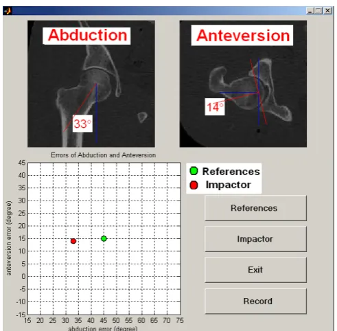 Fig. 3 The software interface of the CupNav system is showed. The  Reference button calculates the coordinate system of the pelvis