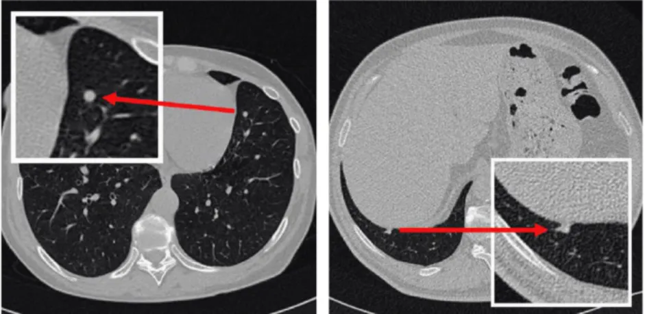 Fig. 2. CAD lung ﬂow chart.