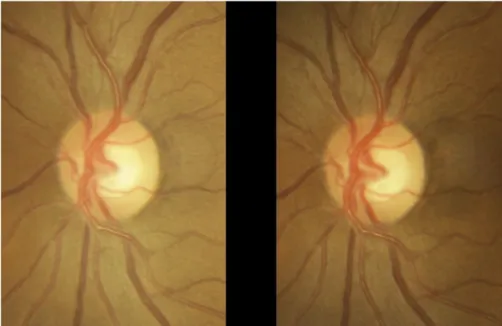 Figure 1.3 Stereo Optic Nerve Head (ONH) image [15] 