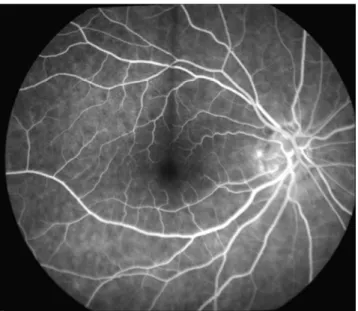 Figure 1.4 illustrates a fluorescein angiogram image of a normal eye in which we can see  that the contrast between vessel and background (other structures) is enhanced